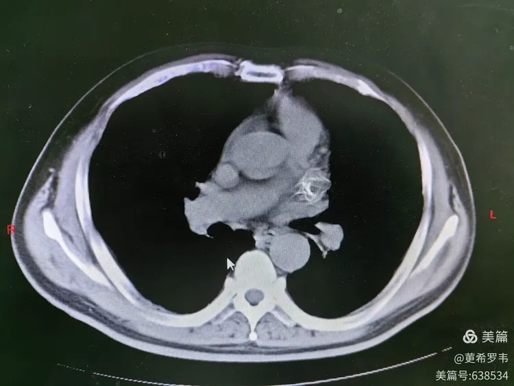 左心耳封堵术后ct表现
